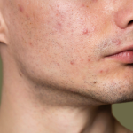 Acne